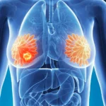 MSOT for human breast cancer